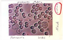 dr_mark_siegal_blood2 dr_mark_siegal_blood2